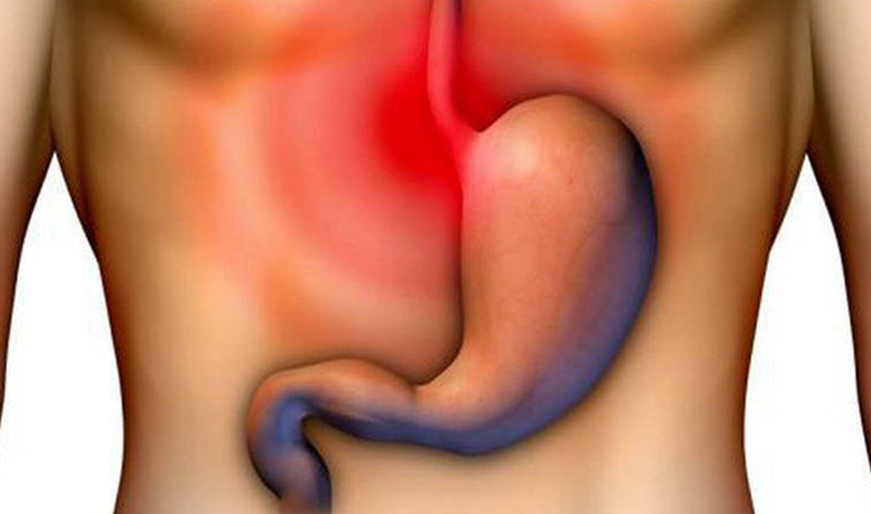 Đau cuống bao tử: Bệnh lý ảnh hưởng đến chất lượng cuộc sống người bệnh 1