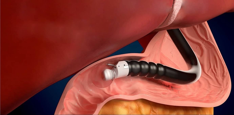 Đau dạ dày nên siêu âm hay nội soi cho kết quả tốt nhất? 1