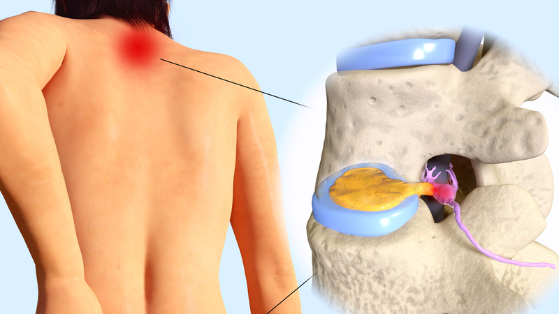 Đau đầu chóng mặt, tê bì chân tay là bệnh gì?