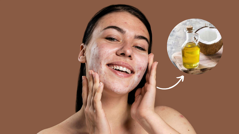 Dầu dừa có trị mụn không? Hướng dẫn dùng dầu dừa đúng cách cho da mụn 3