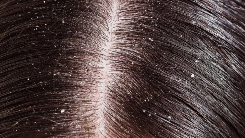 Dầu gội làm sạch gàu Vichy Dercos: Trị gàu hiệu quả! 1