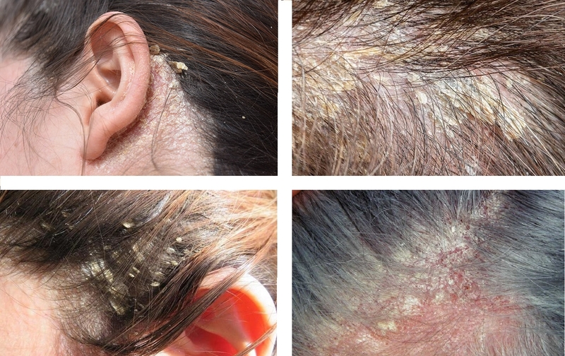 dầu gội trị viêm da tiết bã 1