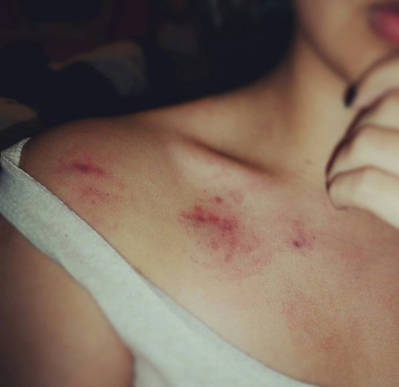 Hickey tiềm ẩn nguy cơ gây đột quỵ