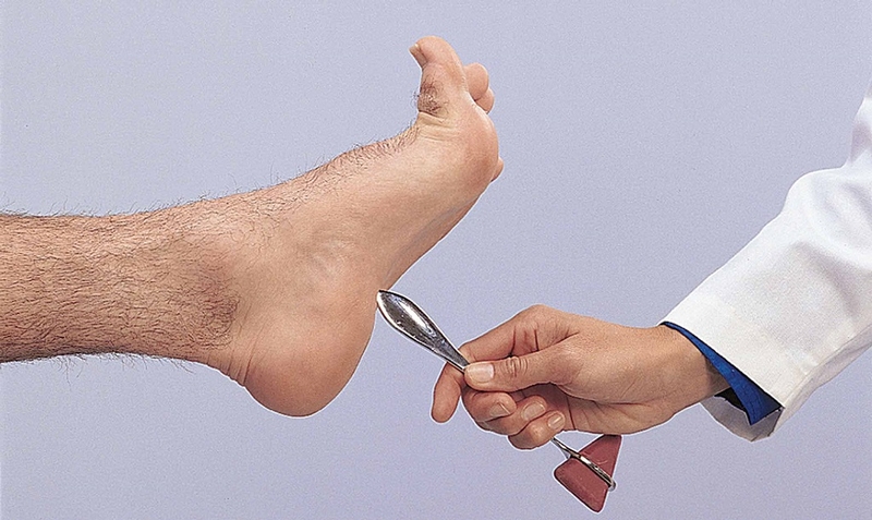 Dấu hiệu Babinski là gì? Cách khám và chẩn đoán dấu hiệu Babinski 3