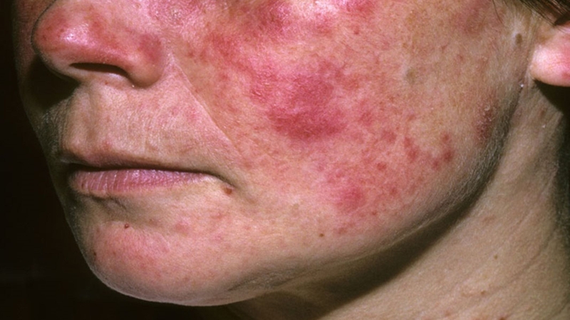 Dấu hiệu bệnh Lupus ban đỏ giai đoạn đầu là gì? Những lưu ý cần biết 1