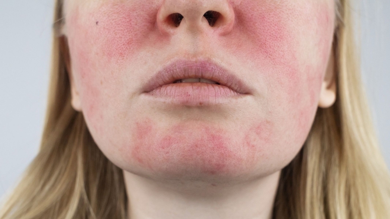 Dấu hiệu bệnh Lupus ban đỏ giai đoạn đầu là gì? Những lưu ý cần biết 2