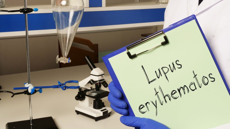 Dấu hiệu bệnh Lupus ban đỏ giai đoạn đầu là gì? Những lưu ý cần biết 4