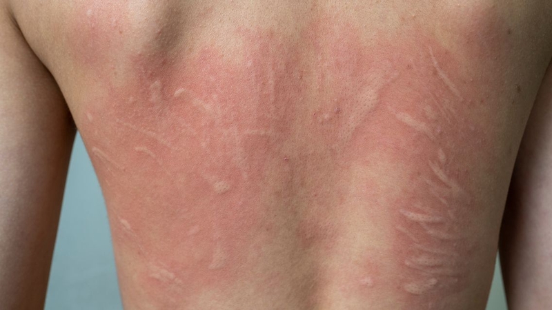 Dấu hiệu bị giun sán ở người lớn cần đề cao cảnh giác 2