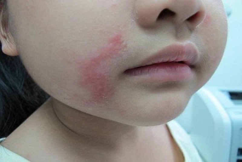 Dấu hiệu bị kiến ba khoang cắn là gì