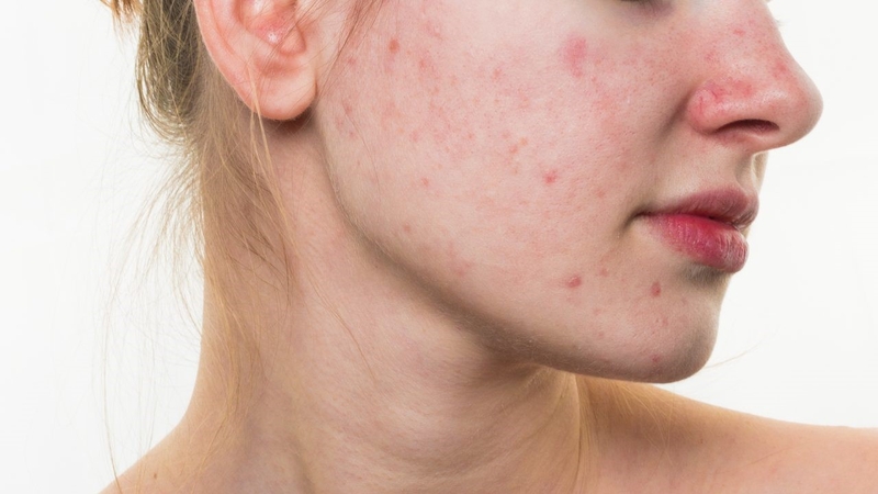 Dấu hiệu bị mụn nội tiết và cách chăm sóc da mụn 2