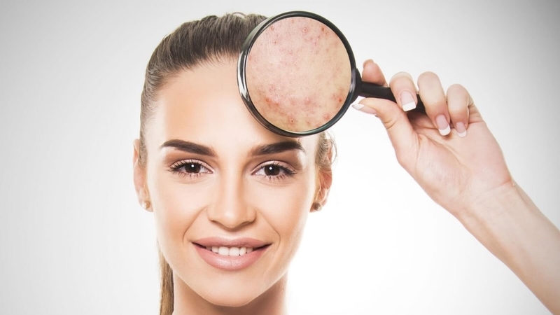 Dấu hiệu bị mụn nội tiết và cách chăm sóc da mụn 3