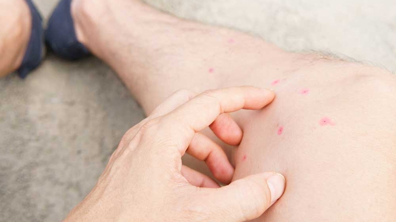 Dấu hiệu bọ chét cắn là gì? Cần làm gì khi bị bọ chét cắn 2