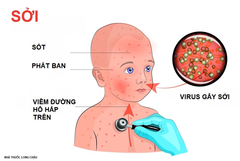 Dấu hiệu các nốt sởi và phân biệt với sốt phát ban 1