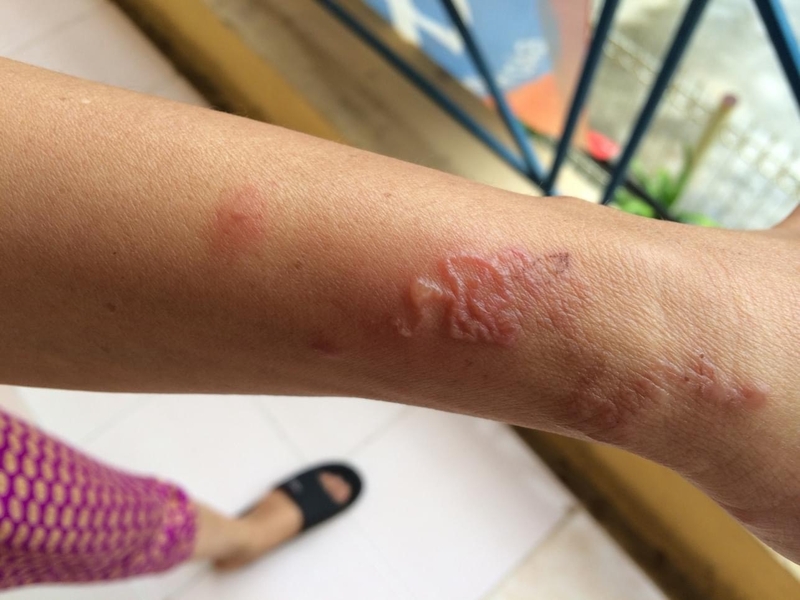 Dấu hiệu cần tẩy giun ở người lớn 3