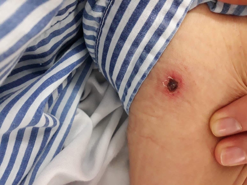 Dấu hiệu cảnh báo bệnh sốt mò 1