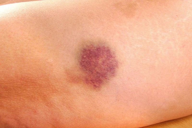 Dấu hiệu cảnh báo ung thư sớm mà ai cũng nên biết 2