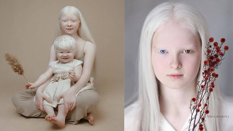 Dấu hiệu của bệnh bạch tạng ở trẻ 2