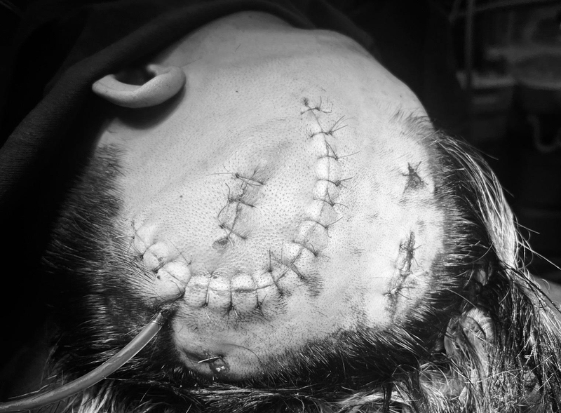 Dấu hiệu đeo kính râm trong chấn thương sọ não là gì? 2