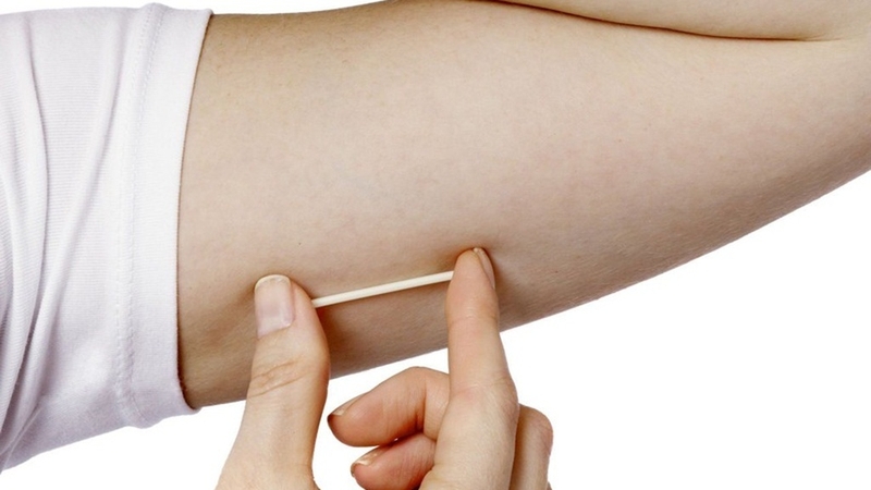 Dấu hiệu dị ứng que cấy tránh thai và cách phòng ngừa 3