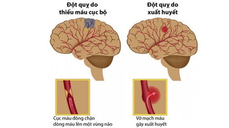 Dấu hiệu đột quỵ trước 30 ngày: Nhận biết và phòng ngừa kịp thời 1