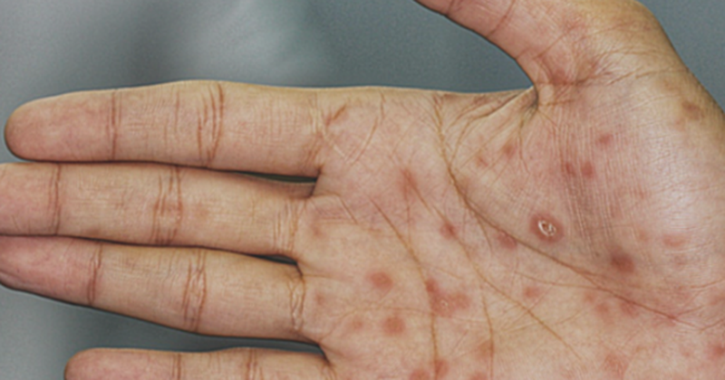 Bệnh giang mai là một bệnh nhiễm trùng do vi khuẩn Treponema pallidum gây ra