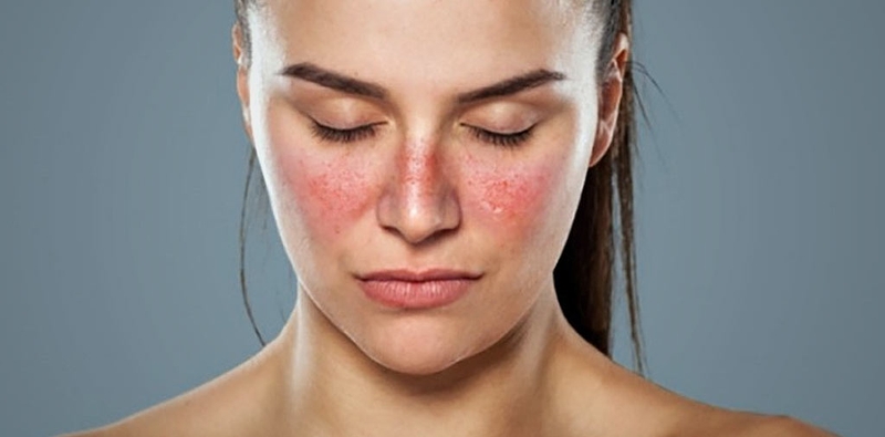 Dấu hiệu giống như dị ứng 2 bên má là bệnh gì 3