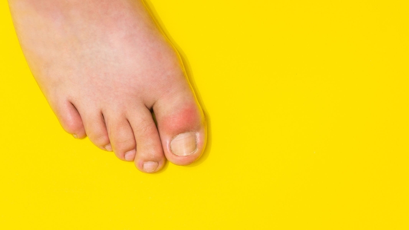 Vị trí thường gặp nhất của gout là khớp bàn, ngón chân cái