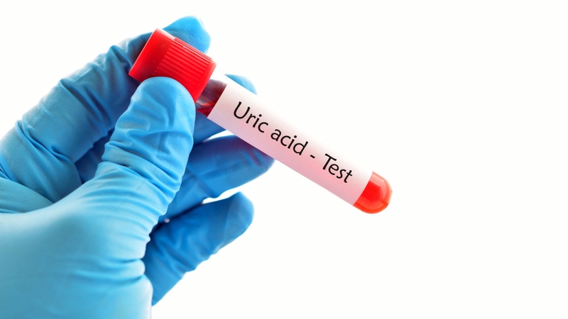 Tăng acid uric máu là yếu tố nguy cơ chính của bệnh gout