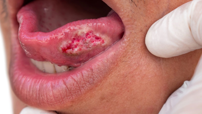Dấu hiệu, hình ảnh ung thư lưỡi giai đoạn cuối dễ nhận biết 1