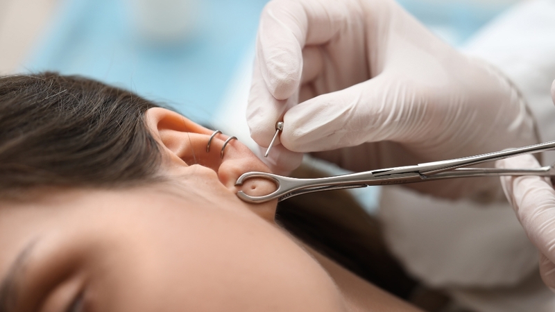 Tìm hiểu chi tiết các dấu hiệu lỗ xỏ lành hoàn toàn