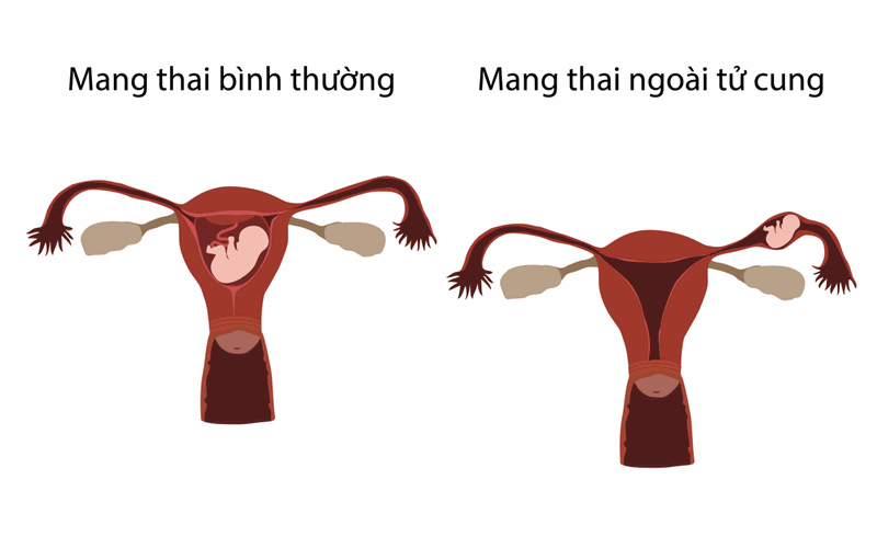 dấu hiệu mang thai ngoài tử cung 1