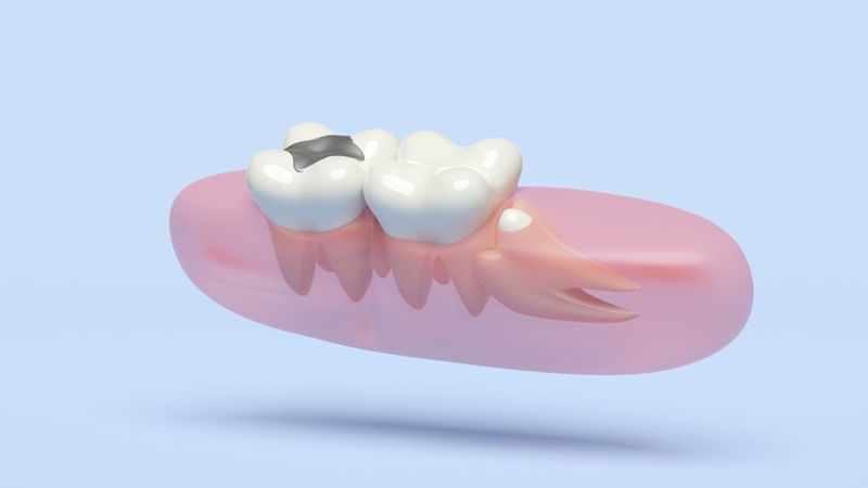 Trong nhiều trường hợp, răng khôn mọc lệch có thể ảnh hưởng đến các răng lân cận