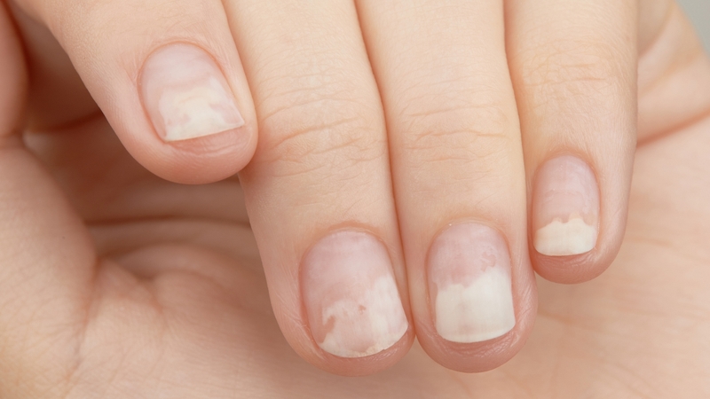 Tình trạng móng dày, xù xì hoặc tách khỏi phần thịt bên dưới có thể là biểu hiện của nhiễm trùng