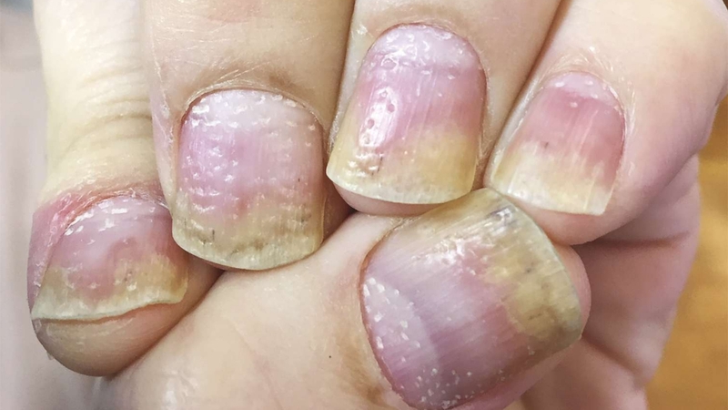 Vảy nến có thể ảnh hưởng trực tiếp đến móng tay, gây ra hiện tượng móng dày, có các lỗ nhỏ li ti trên bề mặt hoặc đổi màu