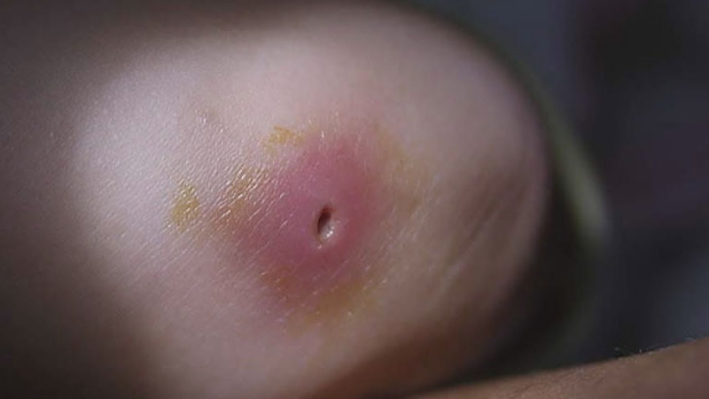 Dấu hiệu mụn nhọt bị nhiễm trùng nào bạn nên đặc biệt chú ý? 2