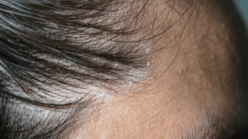 Da đầu bong tróc, vẩy trắng bắt đầu xuất hiện là một trong những dấu hiệu nấm da đầu