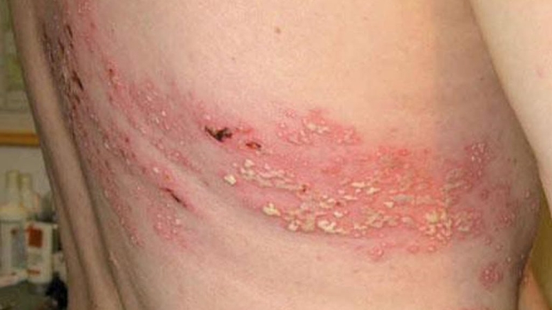 Dấu hiệu nhận biết bệnh giời leo