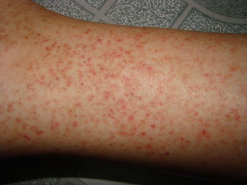 Dấu hiệu nhận biết bệnh viêm nang lông hồng ban hình mạng lưới1