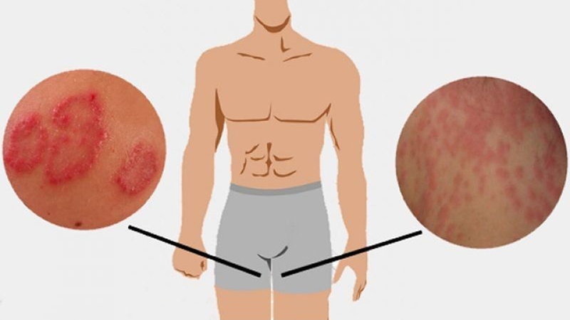 Dấu hiệu nhận biết bị hắc lào ở háng, nguyên nhân và cách chữa trị hiệu quả 1