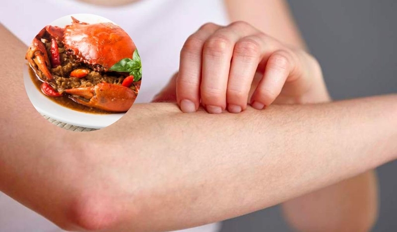 Dấu hiệu điển hình của dị ứng cua nói riêng hay dị ứng hải sản nói chung đều là nổi mẩn đỏ, ngứa ngáy khó chịu