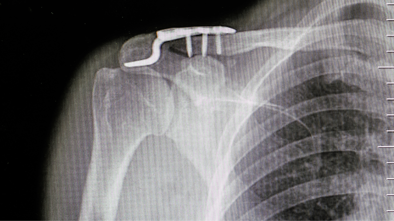 Dấu hiệu nhận biết gãy kín ⅓ xương đòn 2