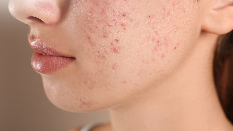 Cách giảm da dầu hiệu quả giúp chị em sở hữu làn da mịn màng, sạch mụn 1