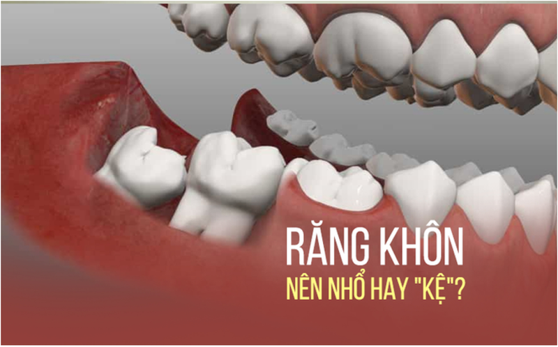 Dấu hiệu nhận biết răng khôn mọc lệch 3