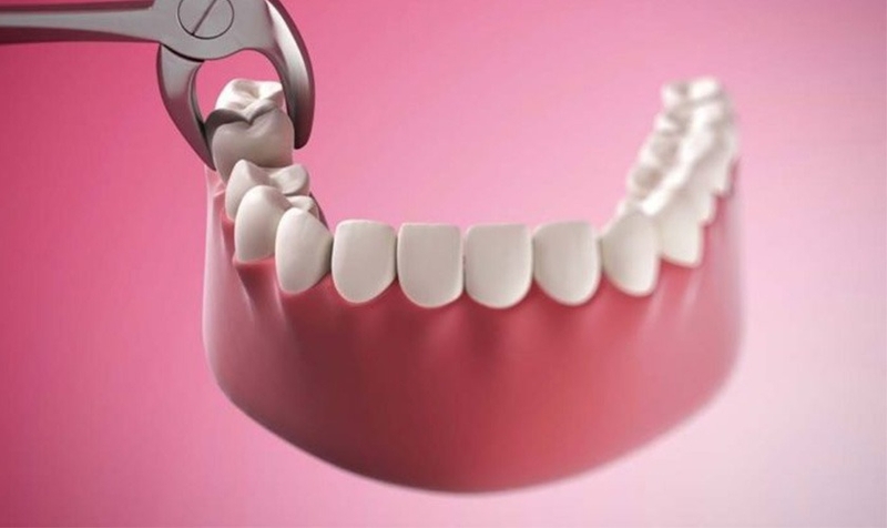 Dấu hiệu nhận biết răng khôn mọc ngầm và biện pháp xử lý hợp lý 3