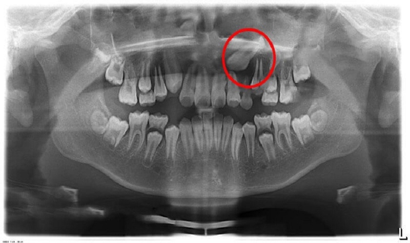 Dấu hiệu nhận biết răng mọc trên lợi và cách xử lý
