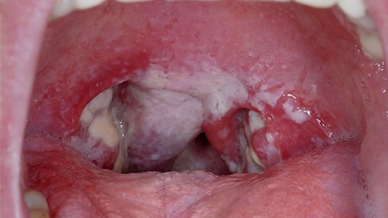 Dấu hiệu nhận biết sớm bệnh bạch hầu và cách phòng ngừa 3