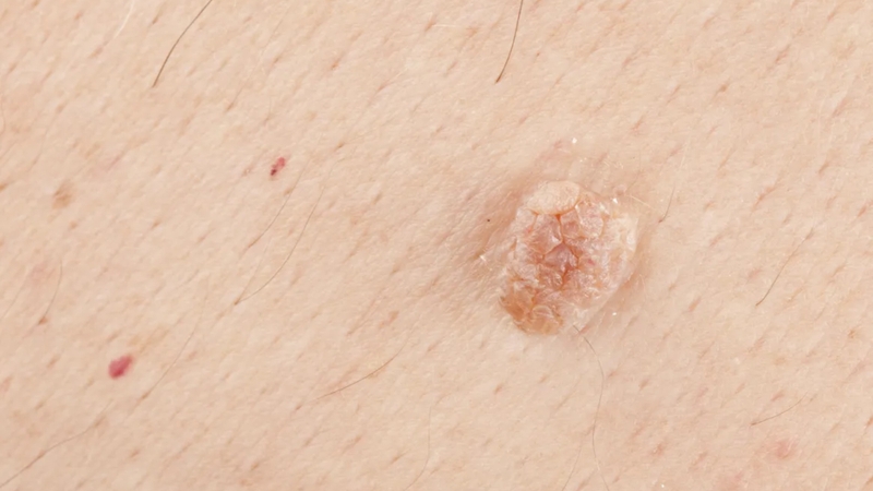 Sùi mào gà giai đoạn đầu là giai đoạn sớm của một bệnh lý lây truyền qua đường tình dục do virus HPV gây ra