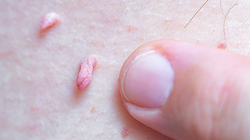 Ban đầu, người bệnh có thể thấy những nốt nhỏ li ti, mềm, màu hồng nhạt hoặc trùng với màu da