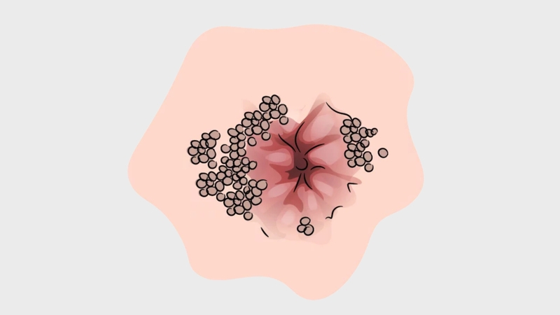 Sùi mào gà có thể xuất hiện vết sùi ở rìa hậu môn hoặc bên trong nếu có quan hệ qua đường này
