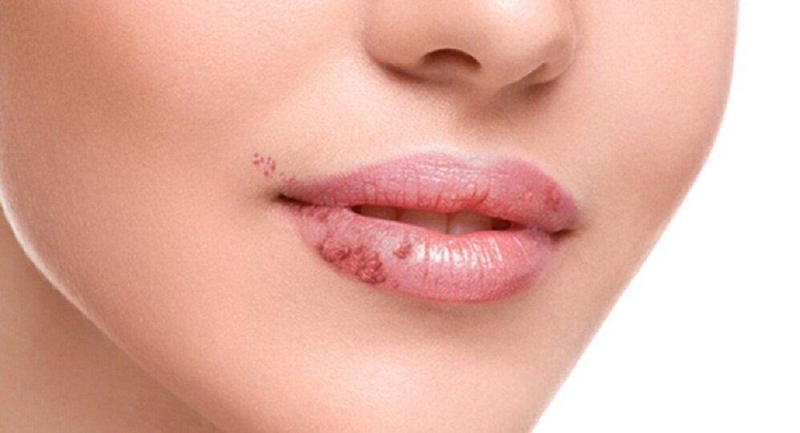 Dấu hiệu nhận biết sùi mào gà ở môi 3